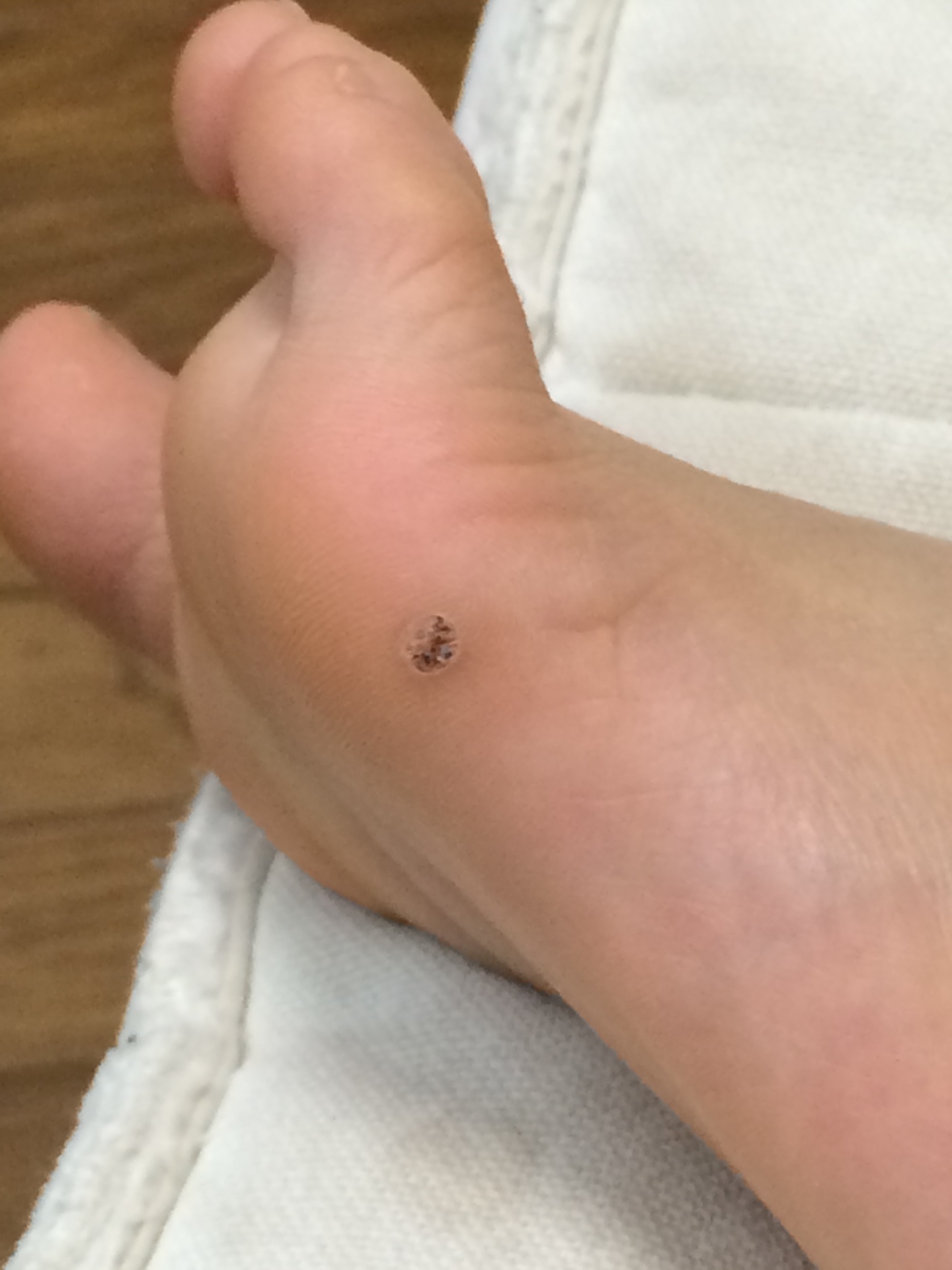 子供の足裏に出来たイボの治療 液体窒素凍結療法 男の育児 サラリーマンパパの育児雑記帳